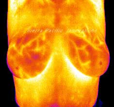 Breast thermography can detect high vascular activity in tissue that is abnormal and a marker for cancerous cells.